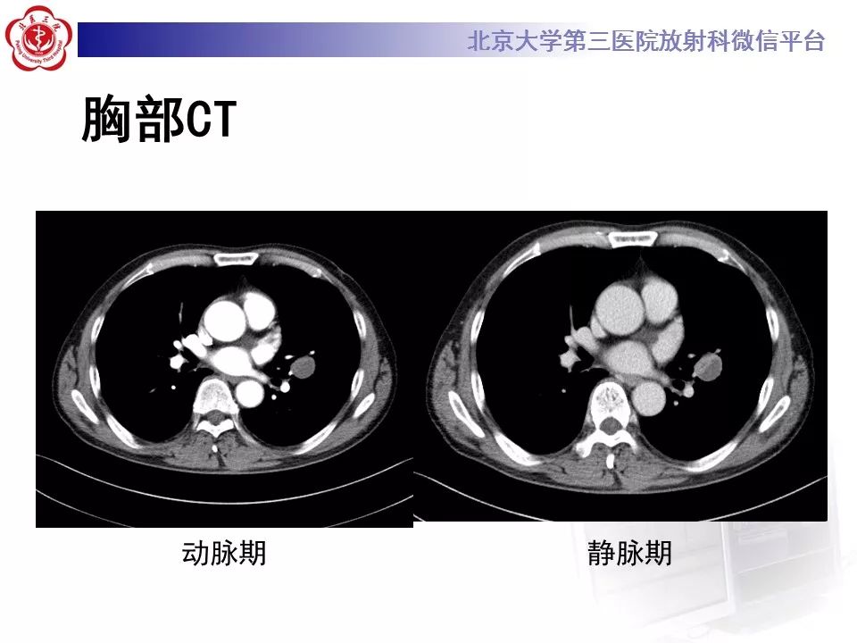 【病例】原发肺神经鞘瘤1例CT影像表现