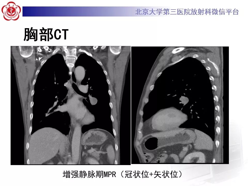 【病例】原发肺神经鞘瘤1例CT影像表现