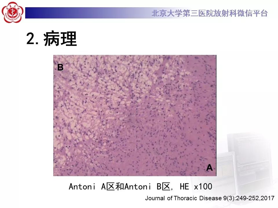 【病例】原发肺神经鞘瘤1例CT影像表现