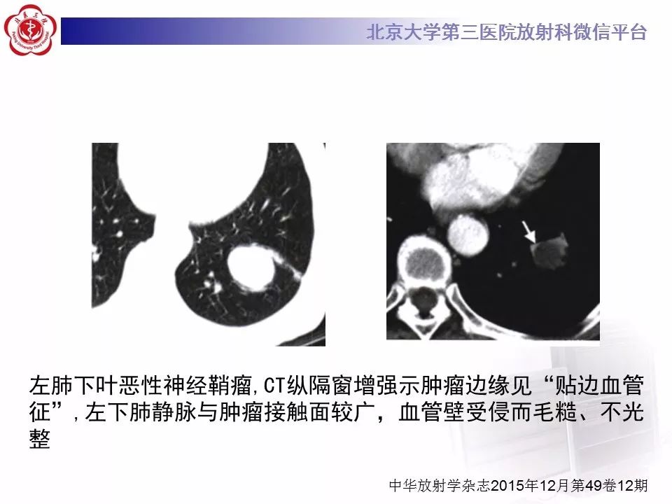 【病例】原发肺神经鞘瘤1例CT影像表现