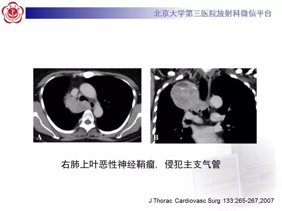 【病例】原发肺神经鞘瘤1例CT影像表现
