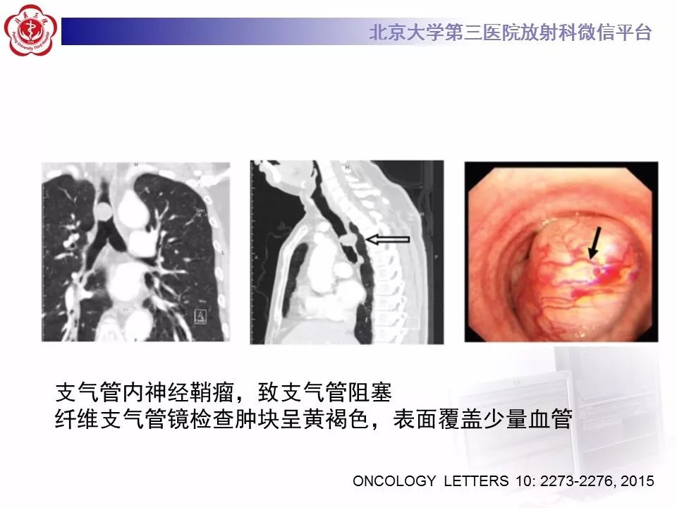 【病例】原发肺神经鞘瘤1例CT影像表现