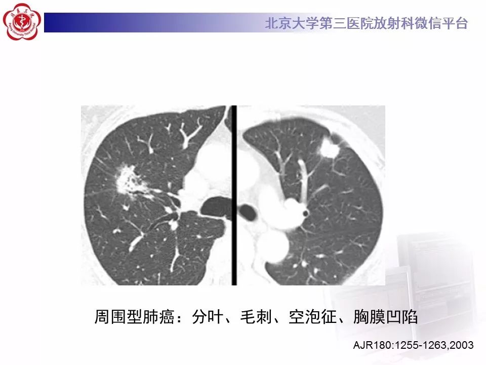 【病例】原发肺神经鞘瘤1例CT影像表现