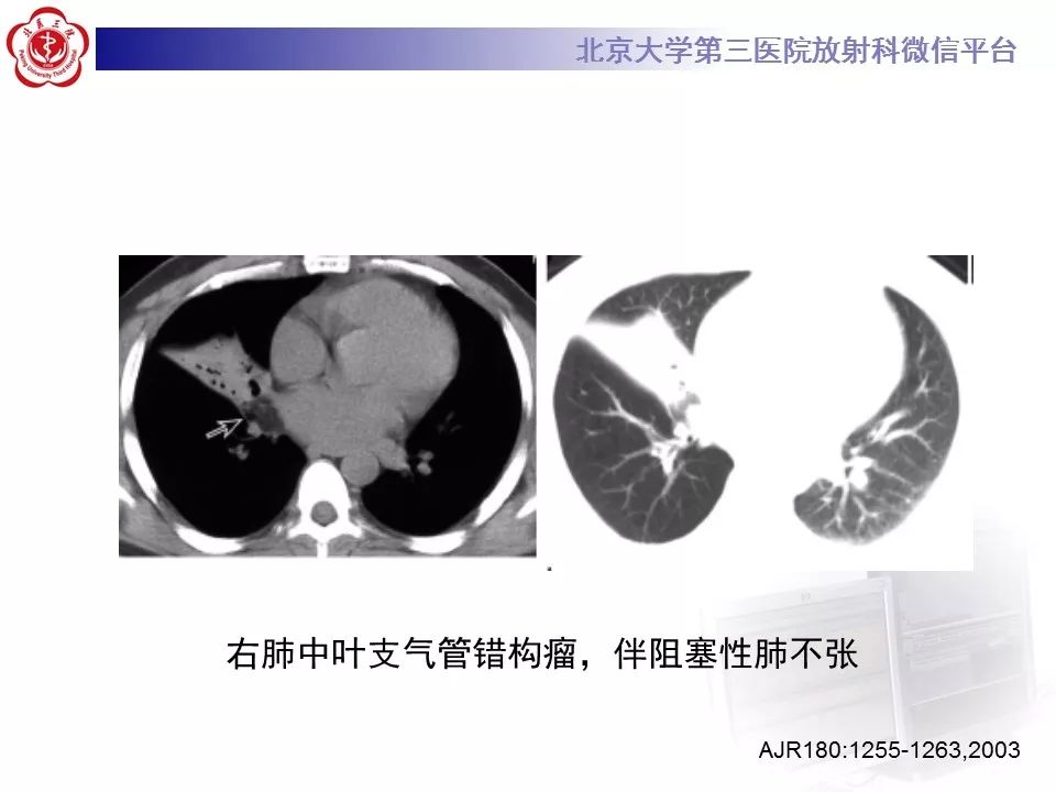 【病例】原发肺神经鞘瘤1例CT影像表现