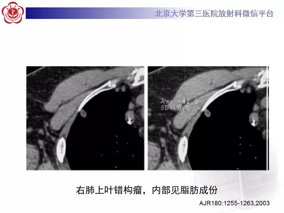 【病例】原发肺神经鞘瘤1例CT影像表现