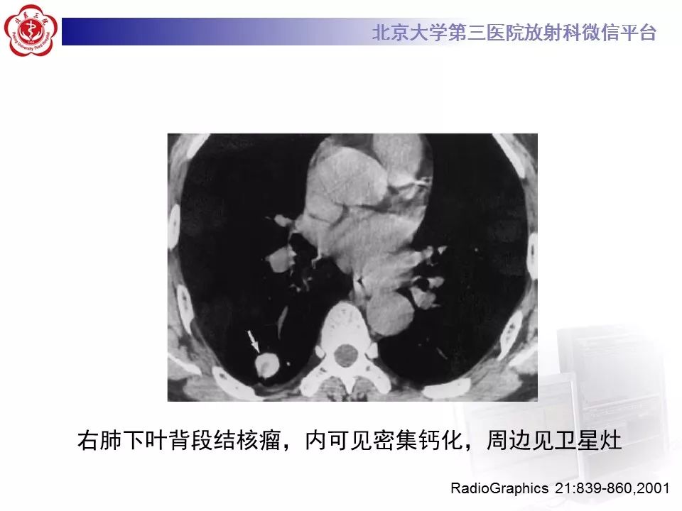 【病例】原发肺神经鞘瘤1例CT影像表现