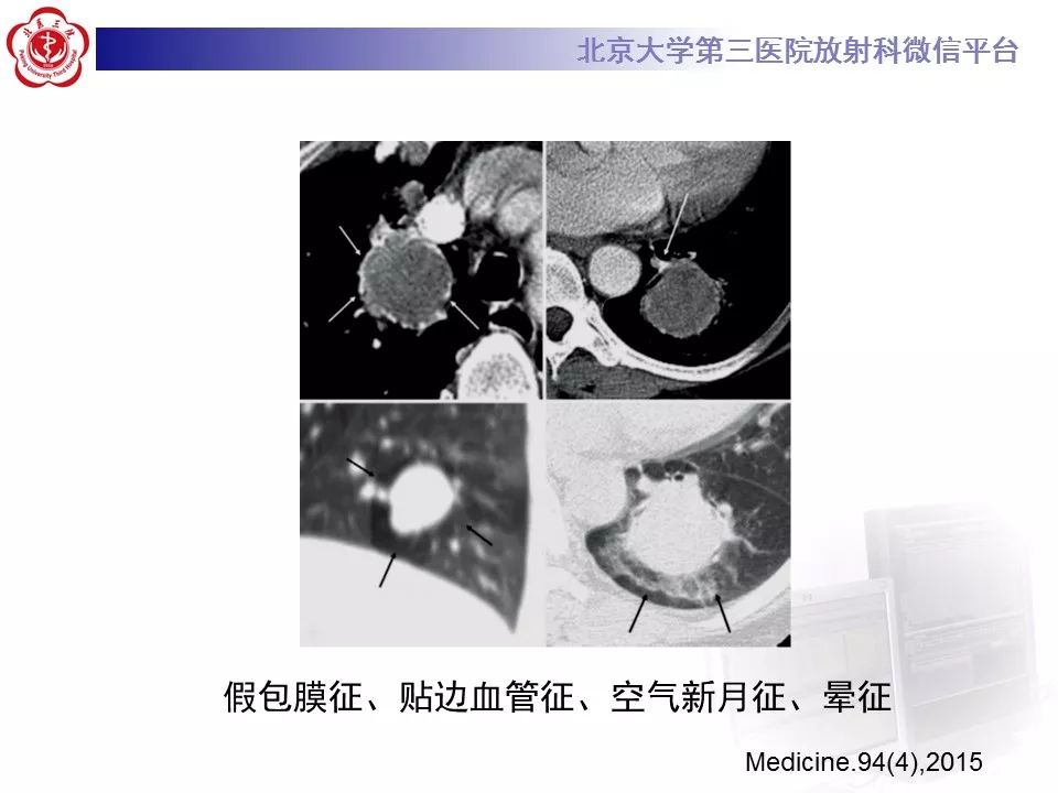 【病例】原发肺神经鞘瘤1例CT影像表现