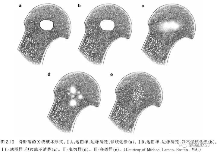 如何评估骨病变——骨破坏的形式和病变的边缘 如何评估骨病变——骨破坏的形式和病变的边缘