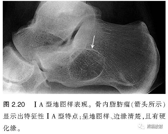 如何评估骨病变——骨破坏的形式和病变的边缘 如何评估骨病变——骨破坏的形式和病变的边缘