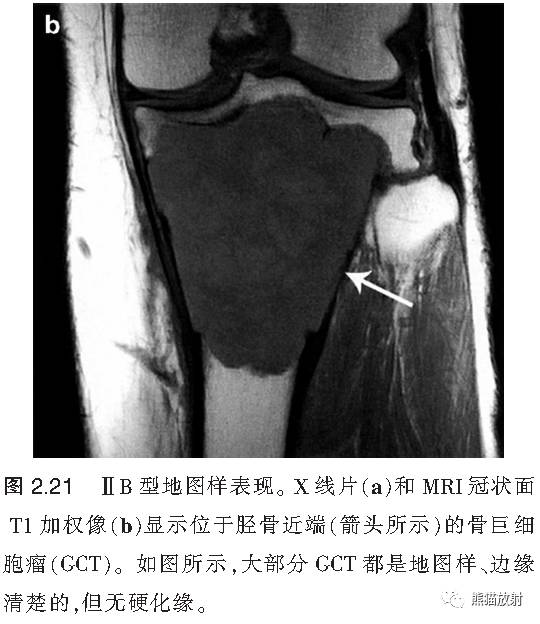 如何评估骨病变——骨破坏的形式和病变的边缘 如何评估骨病变——骨破坏的形式和病变的边缘
