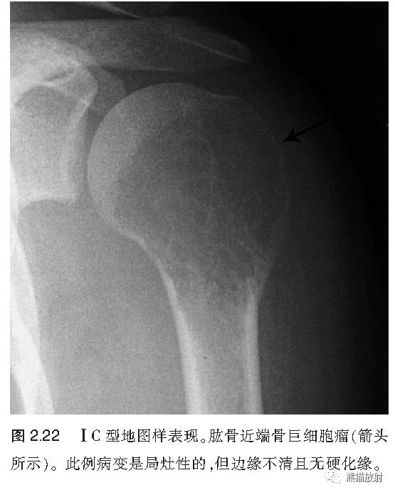 如何评估骨病变——骨破坏的形式和病变的边缘 如何评估骨病变——骨破坏的形式和病变的边缘