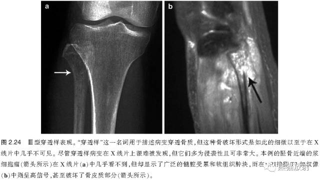如何评估骨病变——骨破坏的形式和病变的边缘 如何评估骨病变——骨破坏的形式和病变的边缘