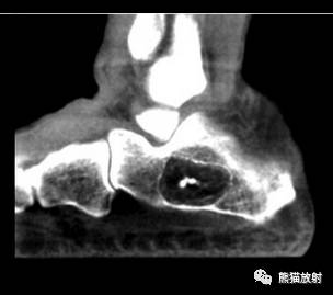 如何评估骨病变——骨破坏的形式和病变的边缘 如何评估骨病变——骨破坏的形式和病变的边缘