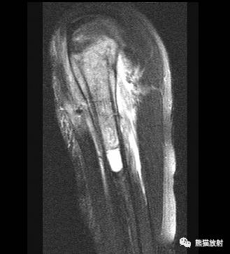 如何评估骨病变——骨破坏的形式和病变的边缘 如何评估骨病变——骨破坏的形式和病变的边缘