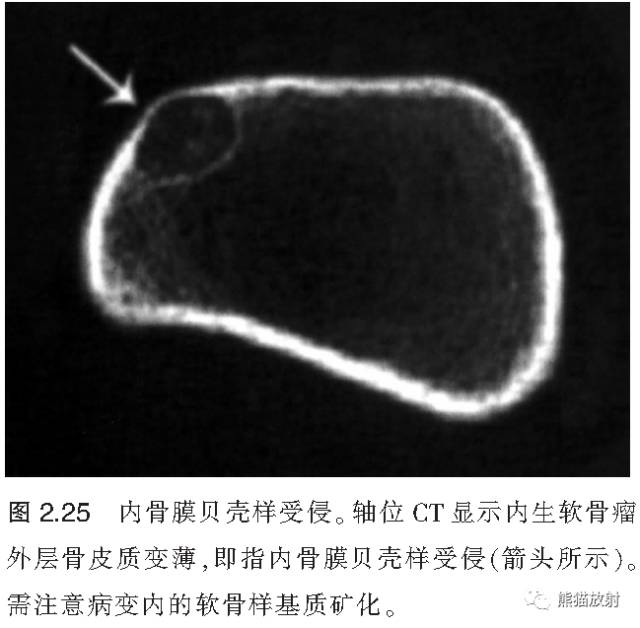 如何评估骨病变——骨破坏的形式和病变的边缘 如何评估骨病变——骨破坏的形式和病变的边缘