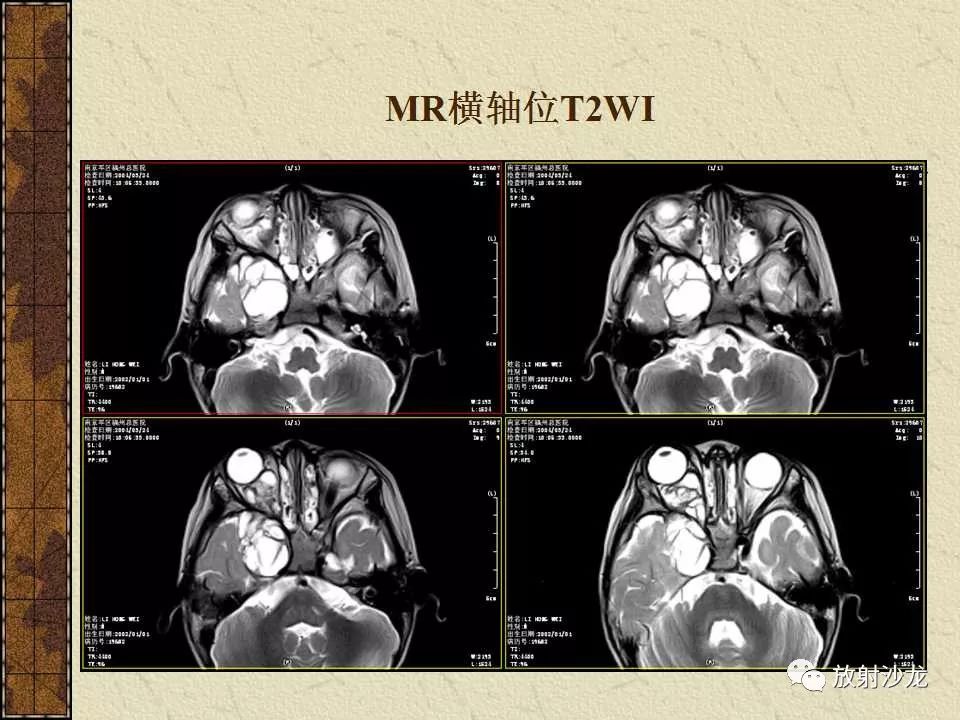 【病例】右侧眼眶-海绵窦旁畸胎瘤1例MR