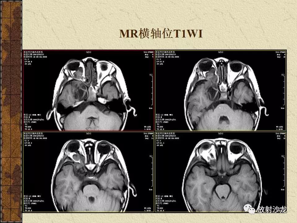 【病例】右侧眼眶-海绵窦旁畸胎瘤1例MR