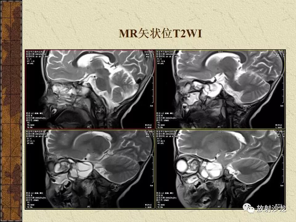 【病例】右侧眼眶-海绵窦旁畸胎瘤1例MR