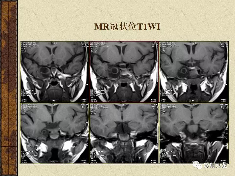 【病例】右侧眼眶-海绵窦旁畸胎瘤1例MR