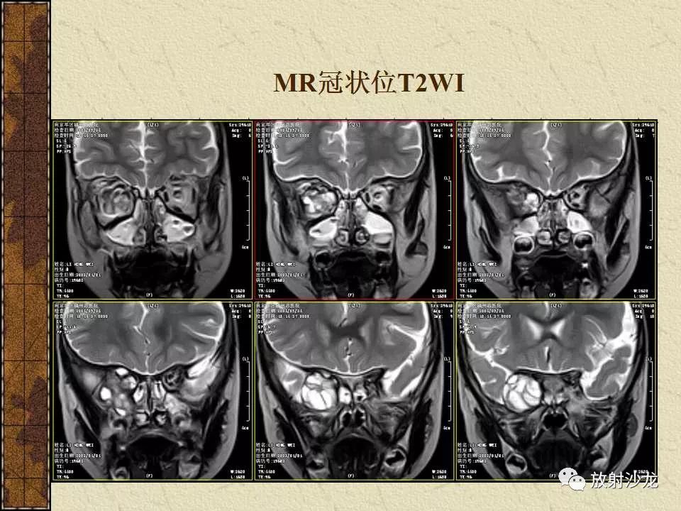 【病例】右侧眼眶-海绵窦旁畸胎瘤1例MR