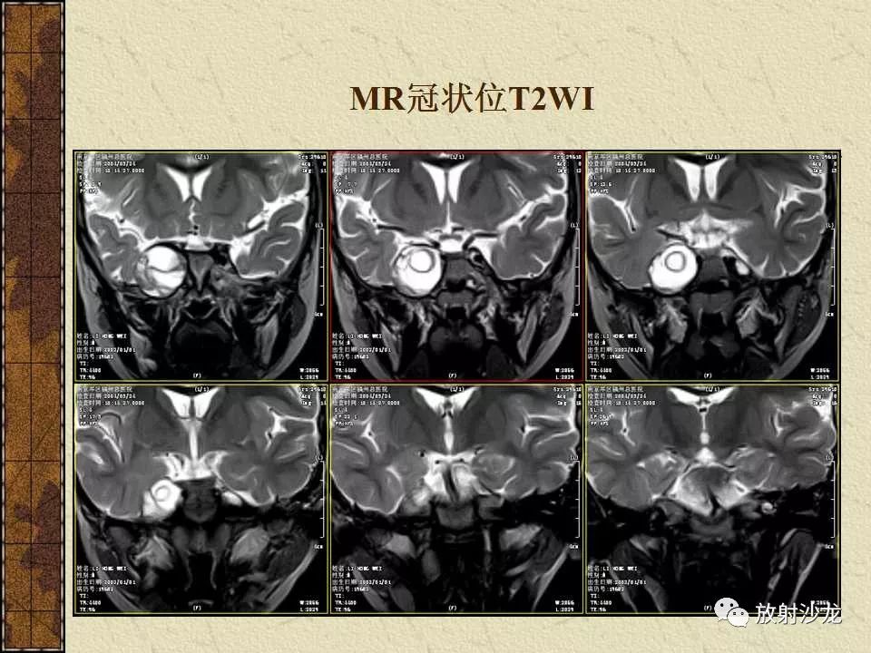 【病例】右侧眼眶-海绵窦旁畸胎瘤1例MR