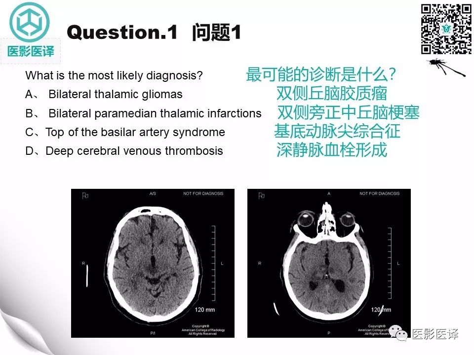 【病例】Percheron动脉梗塞1例CT及MR