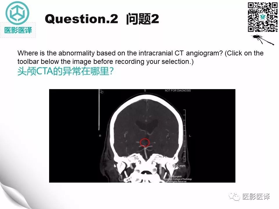 【病例】Percheron动脉梗塞1例CT及MR