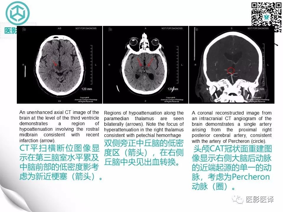 【病例】Percheron动脉梗塞1例CT及MR