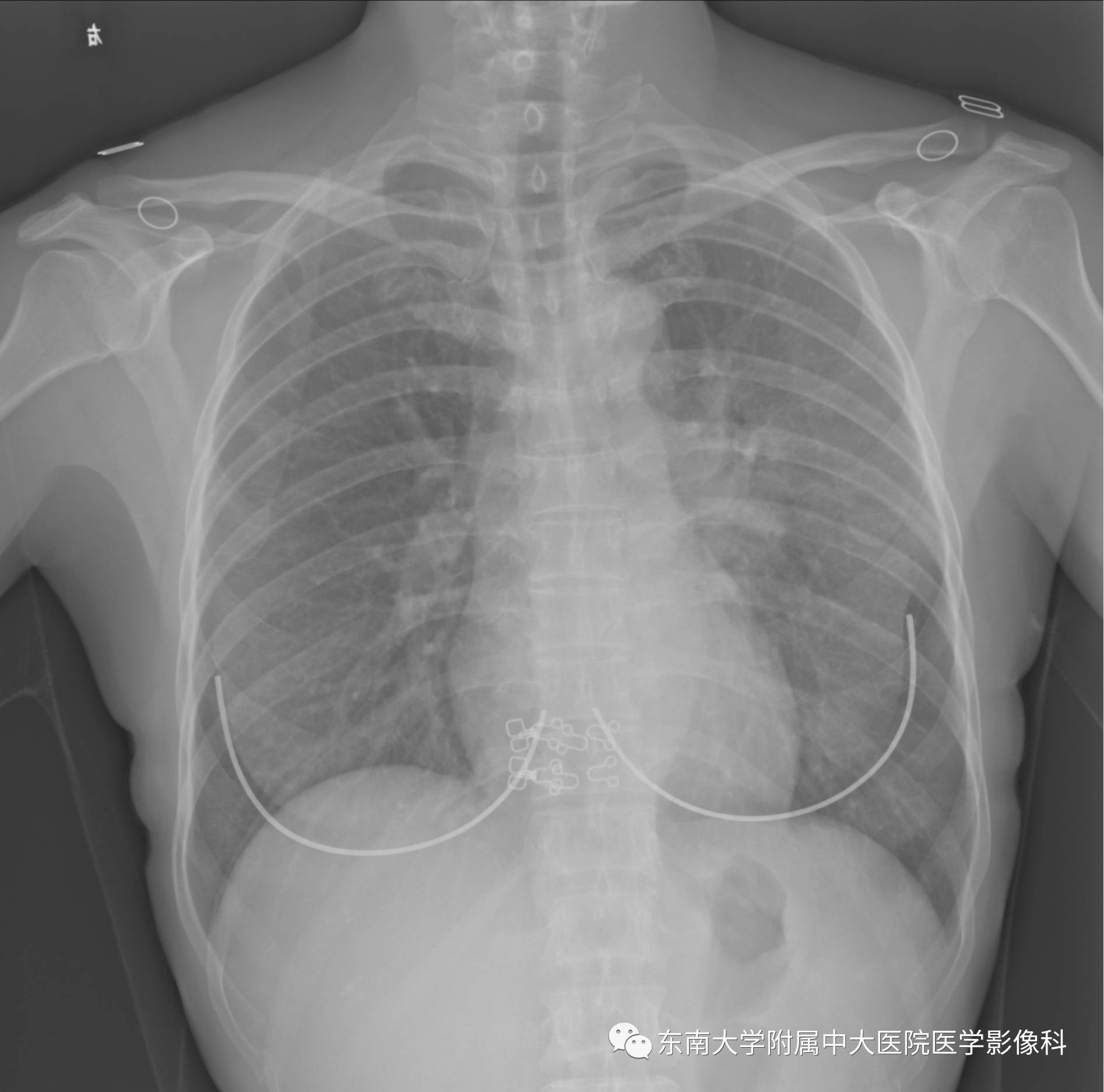 【病例】机化性肺炎1例CT影像表现 【病例】机化性肺炎1例CT影像表现