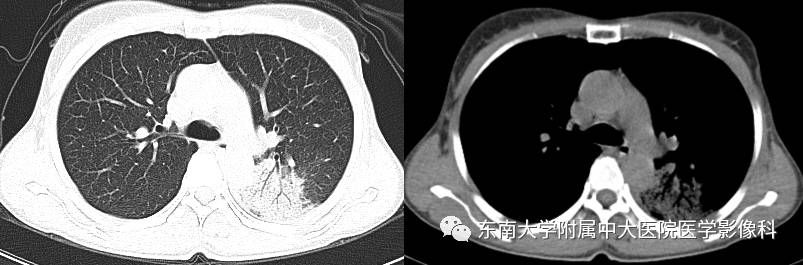 【病例】机化性肺炎1例CT影像表现