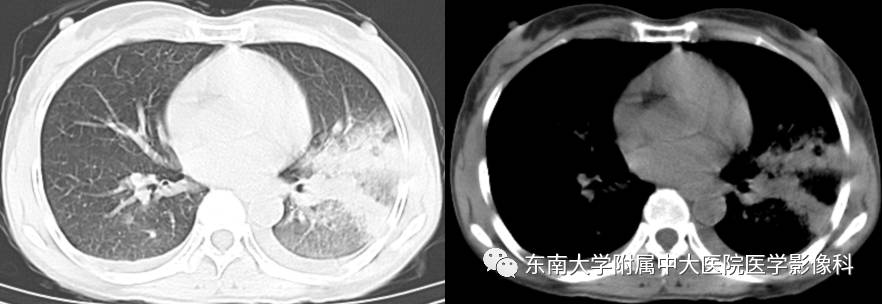 【病例】机化性肺炎1例CT影像表现 【病例】机化性肺炎1例CT影像表现