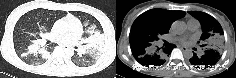 【病例】机化性肺炎1例CT影像表现 【病例】机化性肺炎1例CT影像表现