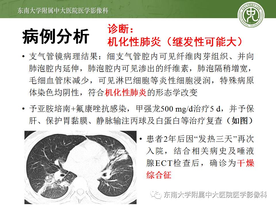 【病例】机化性肺炎1例CT影像表现 【病例】机化性肺炎1例CT影像表现
