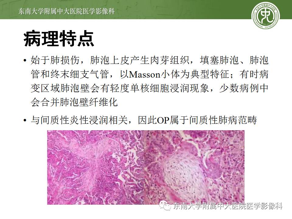 【病例】机化性肺炎1例CT影像表现 【病例】机化性肺炎1例CT影像表现