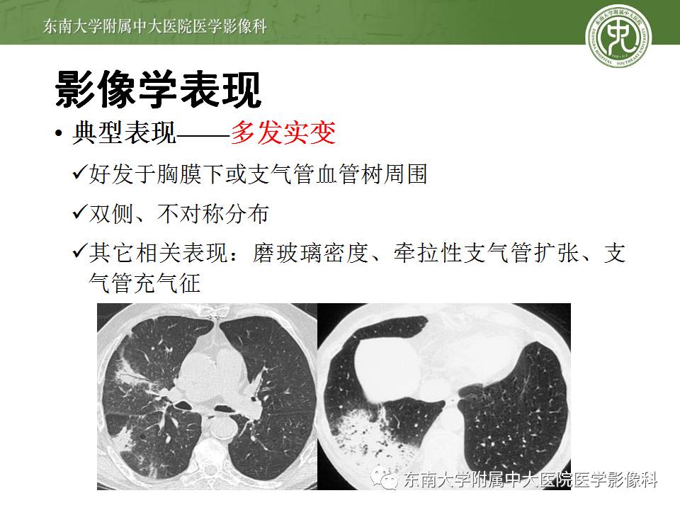 【病例】机化性肺炎1例CT影像表现 【病例】机化性肺炎1例CT影像表现