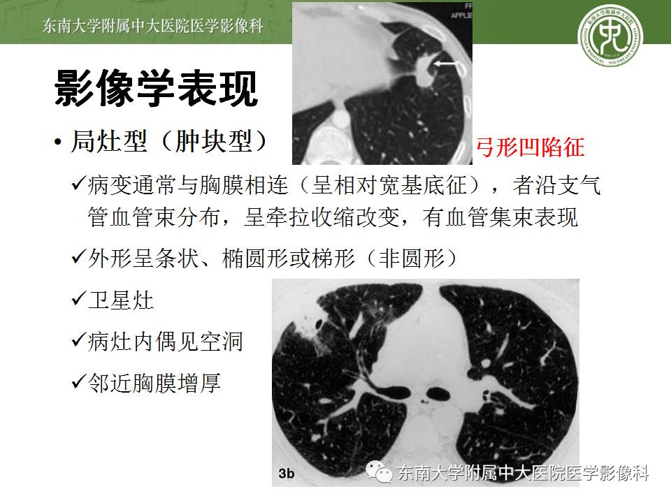 【病例】机化性肺炎1例CT影像表现 【病例】机化性肺炎1例CT影像表现