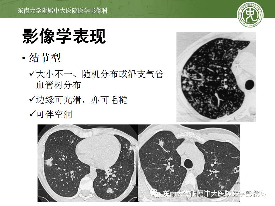【病例】机化性肺炎1例CT影像表现 【病例】机化性肺炎1例CT影像表现