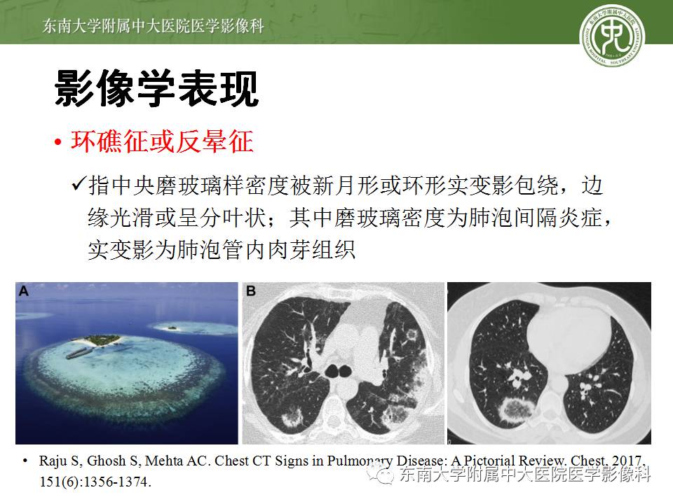 【病例】机化性肺炎1例CT影像表现 【病例】机化性肺炎1例CT影像表现