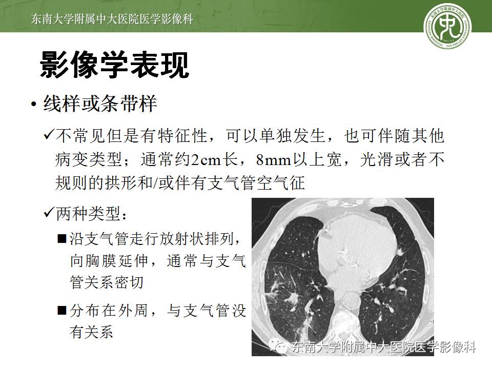 【病例】机化性肺炎1例CT影像表现 【病例】机化性肺炎1例CT影像表现