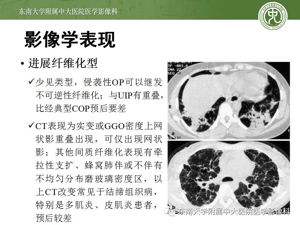 【病例】机化性肺炎1例CT影像表现 【病例】机化性肺炎1例CT影像表现