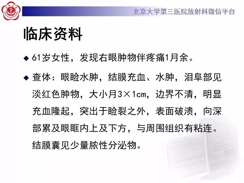 【病例】眼眶淋巴瘤1例CT影像表现