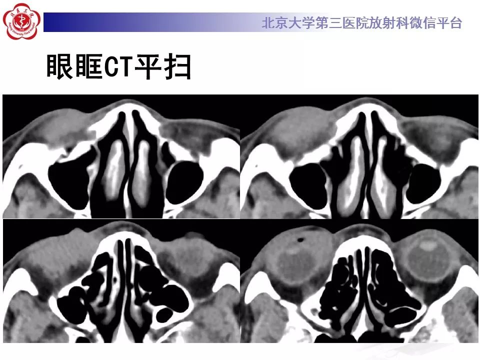 【病例】眼眶淋巴瘤1例CT影像表现