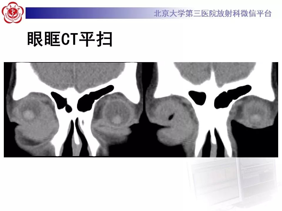 【病例】眼眶淋巴瘤1例CT影像表现