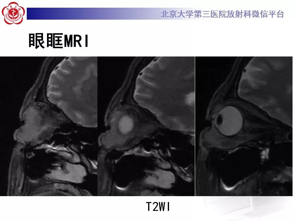 【病例】眼眶淋巴瘤1例CT影像表现