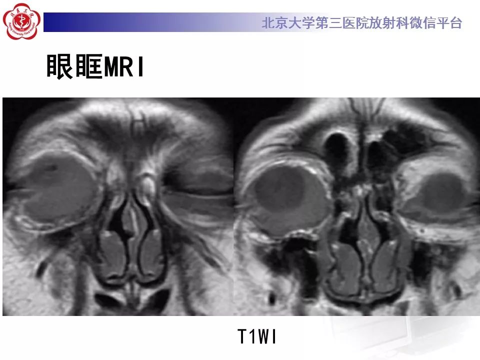 【病例】眼眶淋巴瘤1例CT影像表现
