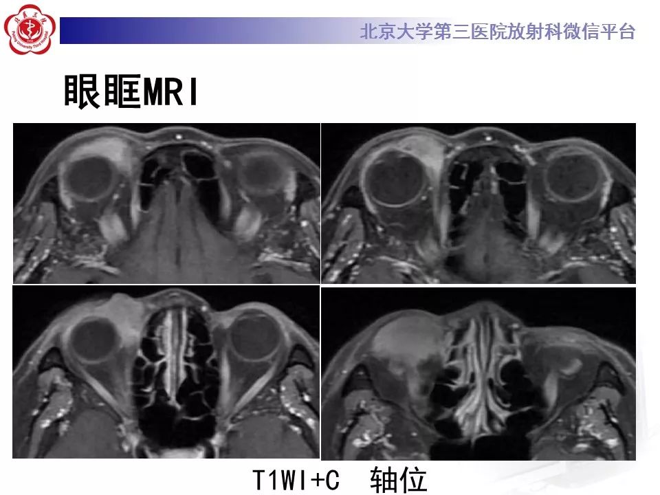 【病例】眼眶淋巴瘤1例CT影像表现