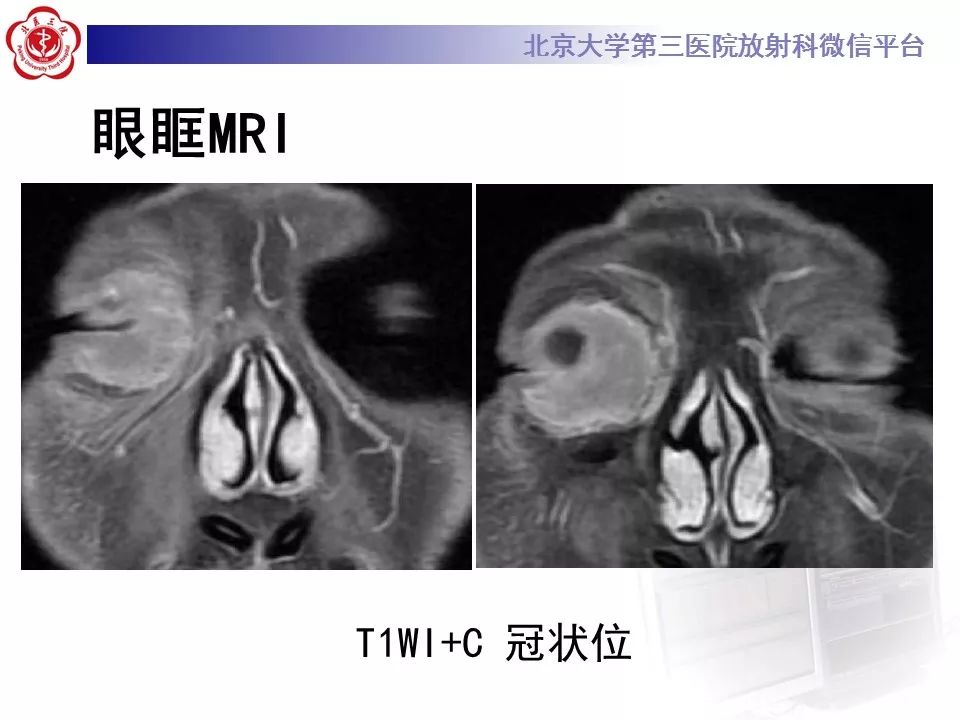 【病例】眼眶淋巴瘤1例CT影像表现