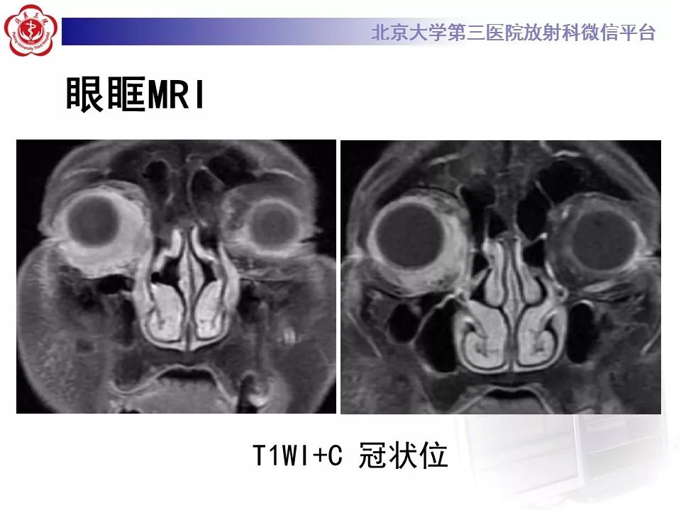【病例】眼眶淋巴瘤1例CT影像表现