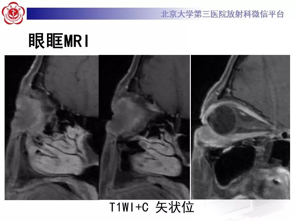 【病例】眼眶淋巴瘤1例CT影像表现