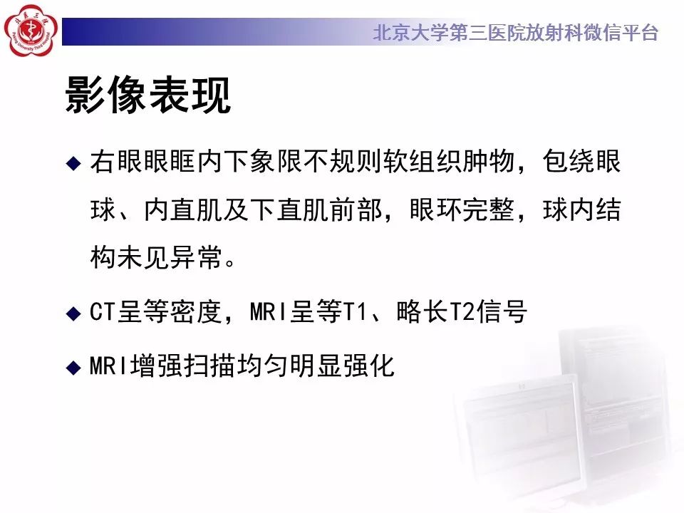 【病例】眼眶淋巴瘤1例CT影像表现